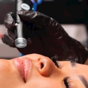 Diamond Hydrafacial package at Estetica Venice